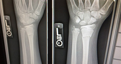 Polymer may lead to better treatments for bone regeneration